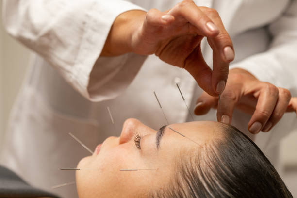 Acupuncture for Migraines